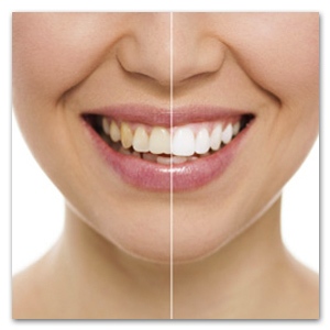 Witte tanden actie bij Mondzorg Dental Beauty