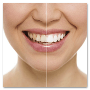 Mondzorg Dental Beauty Bleekactie voor witte tanden