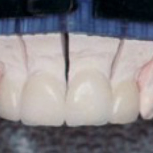 Mondzorg Dental Beauty / Composiet facings