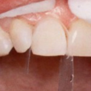 Mondzorg Dental Beauty / Composiet facings