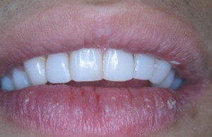 Mondzorg Dental Beauty / Glazuurstoornis